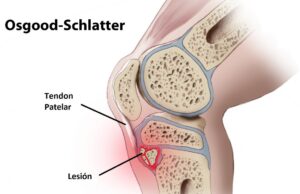 Osgood-Schlatter. Dolor en la rodilla de los jóvenes deportistas. Toni Matas Barceló